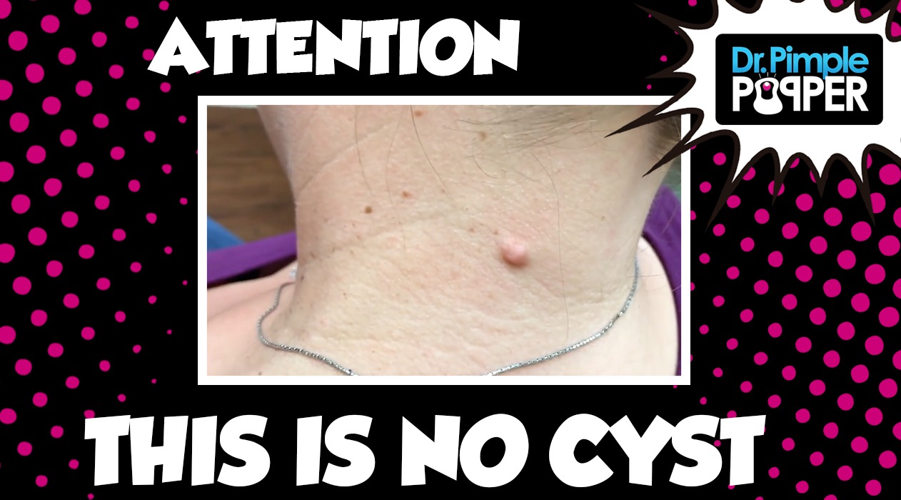 Attention: This is NOT a Cyst