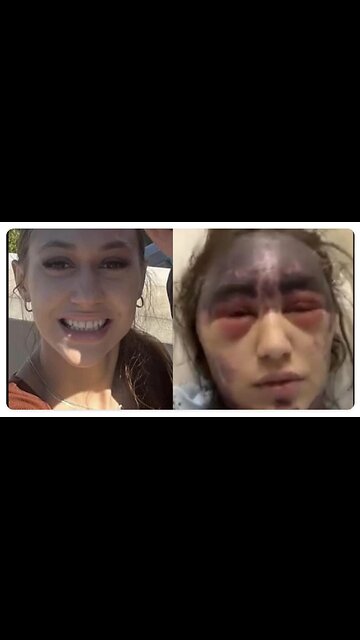 Nemattólvan ! Egy fiatal nő szörnyű egészségkárosodást szenvedett....