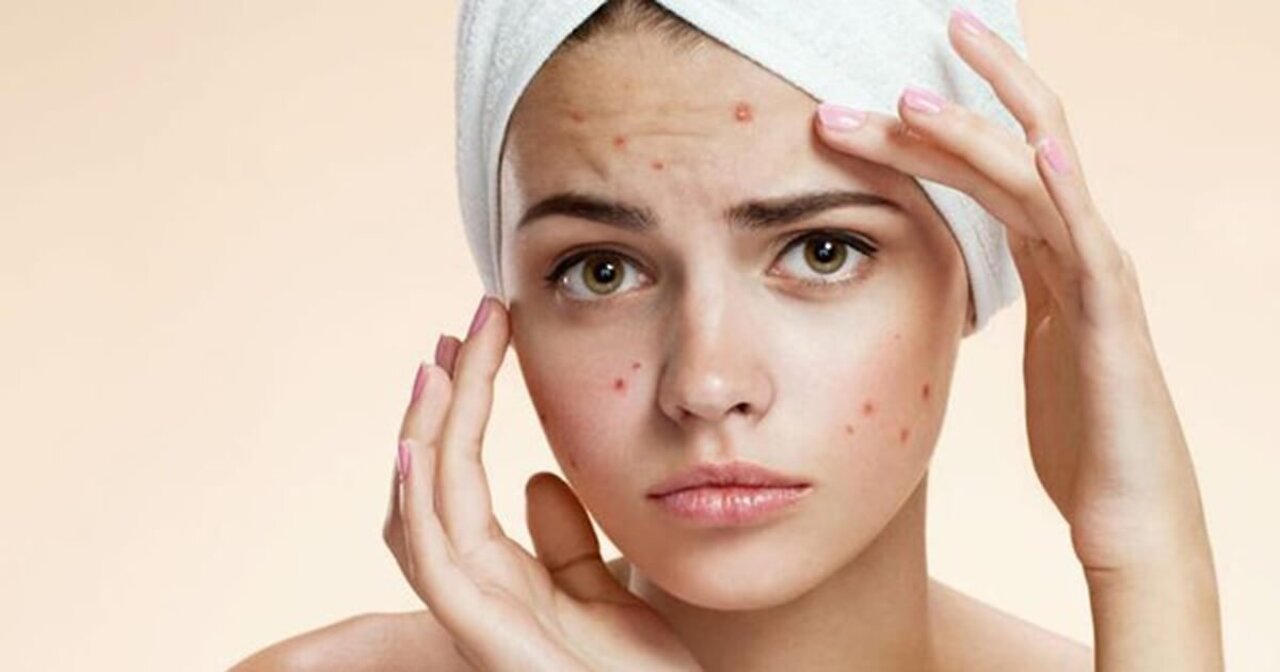 Acne Removal, Pimple Removal