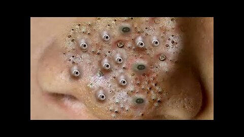 Satisfying blackhead removal, relaxing Pimple Popper 302