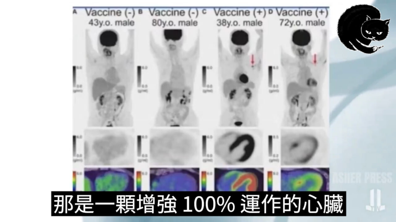 新冠疫苗導致心臟受損的證據, Dr. Chris Shoemaker