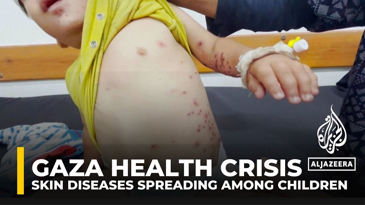 Dangerous skin diseases spreading among children in Gaza