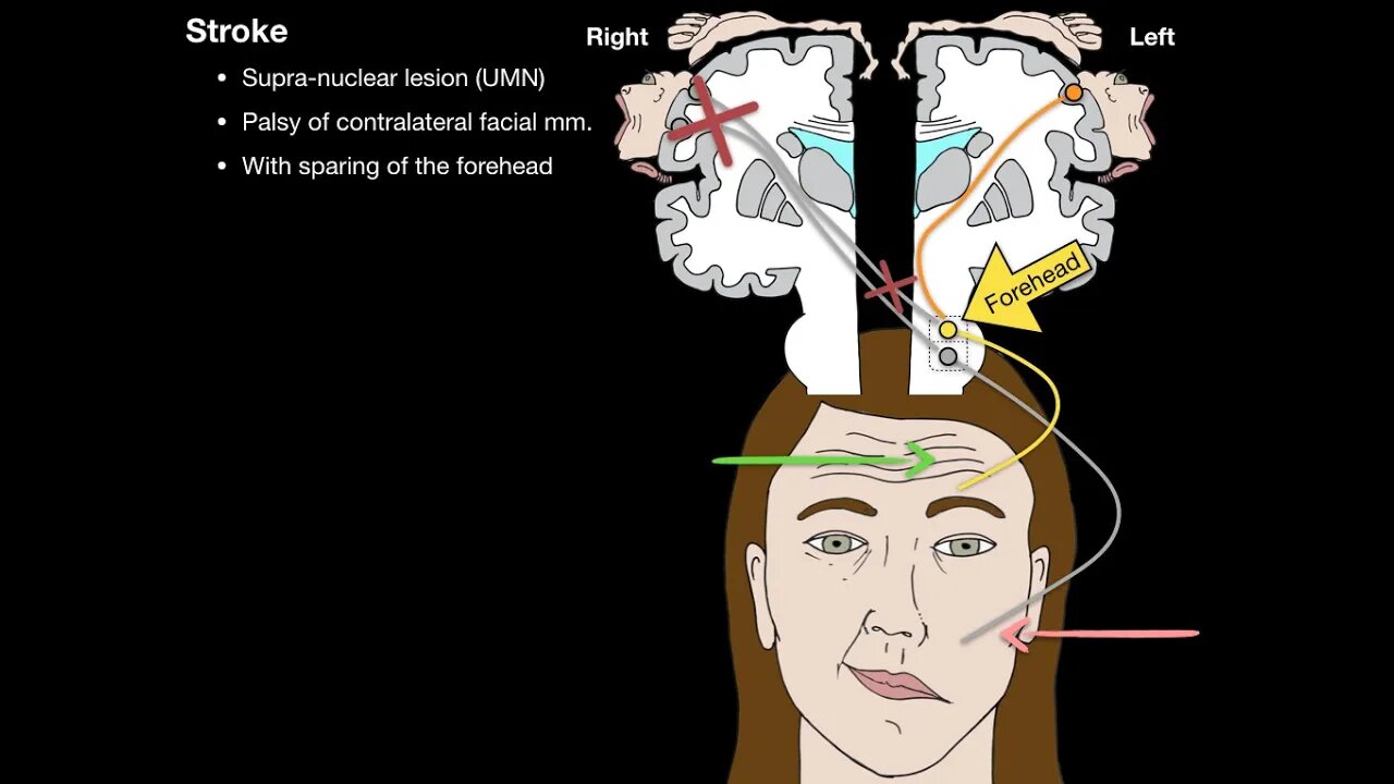 Bells Palsy and Stroke