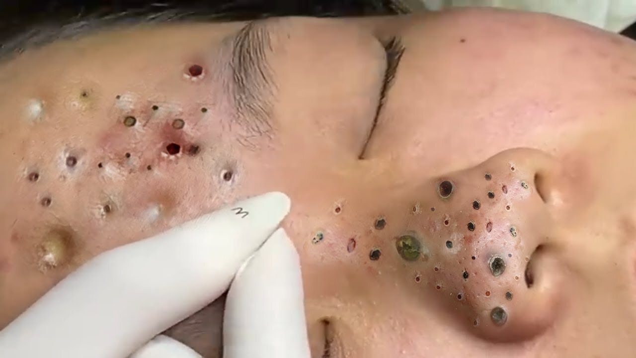 blackhead acen pimple removing