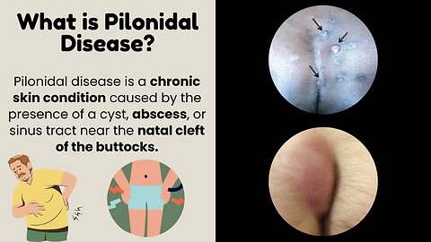 Pilonidal Disease: Comprehensive Overview, Causes, Symptoms, and Management | Novice Medic