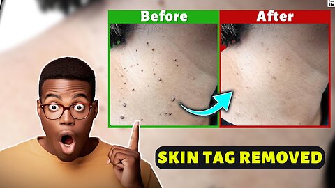 How to get rid of skin tags or warts
