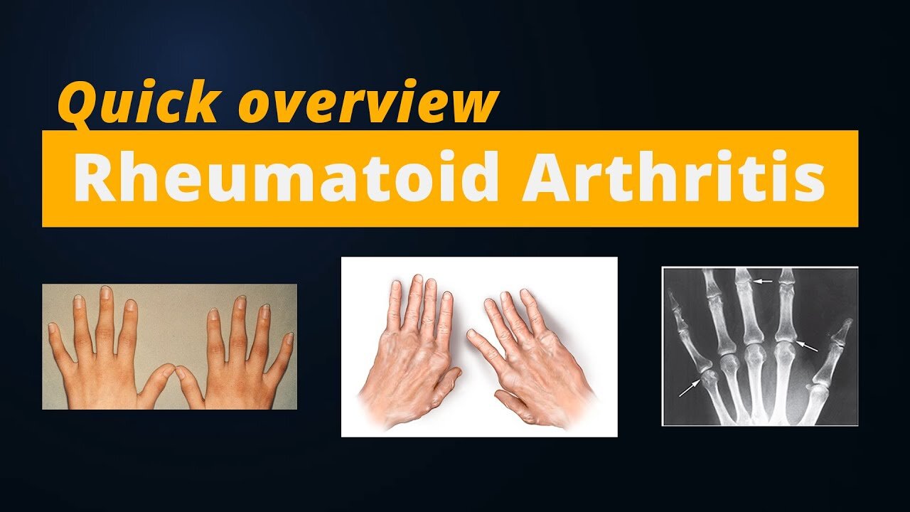 Rheumatoid Arthritis - Quick Revision