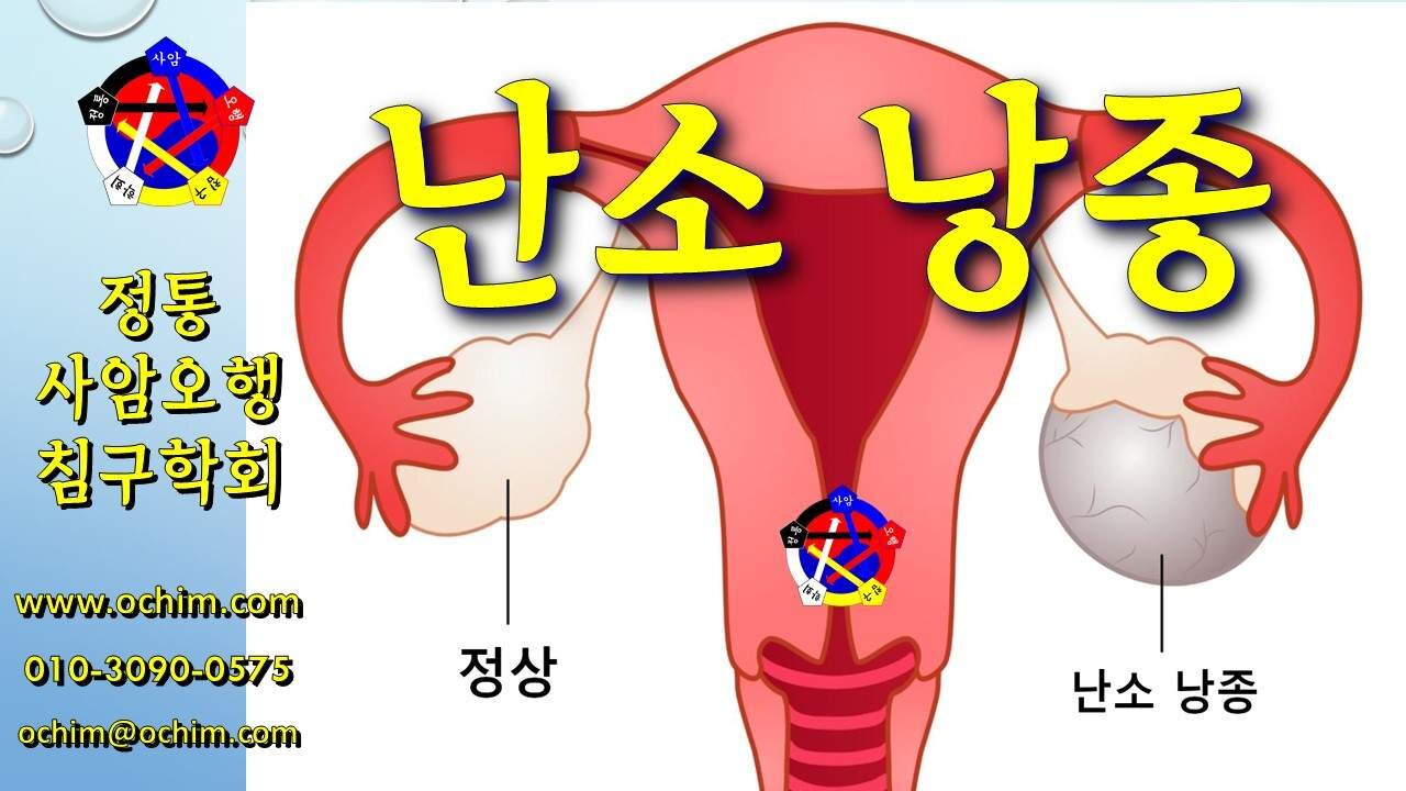 난소낭종 치료 방법 및 사례 - 비과학적 양의학 188 - 사암침, 사암침법, 정통사암침