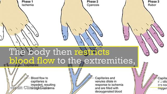 The Mysterious Raynaud's Disease