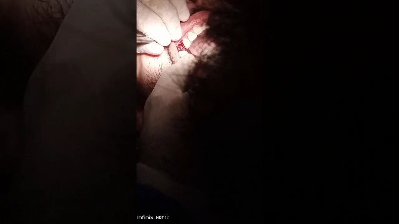 implant surgery