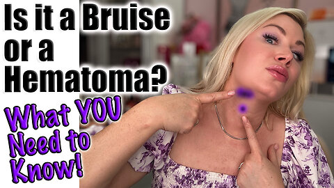 Is It a Bruise of a Hematoma? Let's Discuss! Wannabe Beauty Guru, Code Jessica10 saves you money