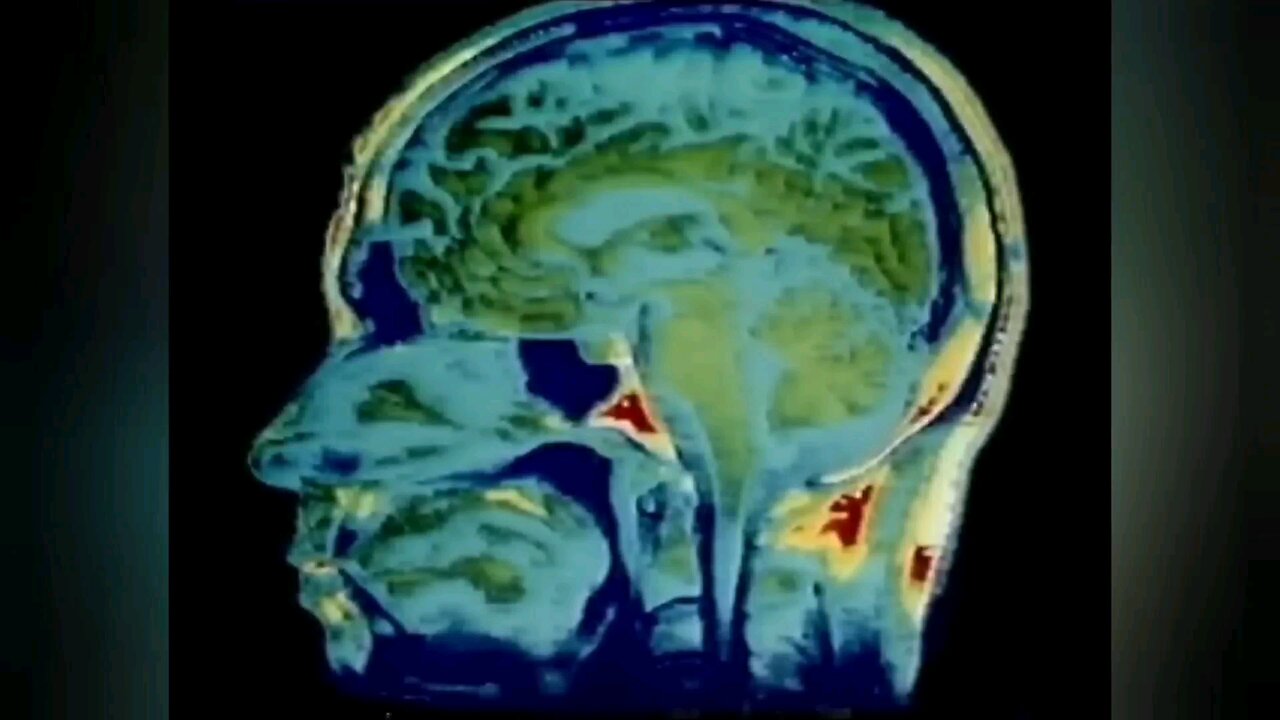 Enteroviruses with Postviral Fatigue Syndrome (PVFS), Persistent Infection & Myalgic Encephalomyelitis (M.E.), Dr. Len Archard investigating Persistent Infection within the Muscle Tissue & Dr. James Mowbray with circulating virus in the blood