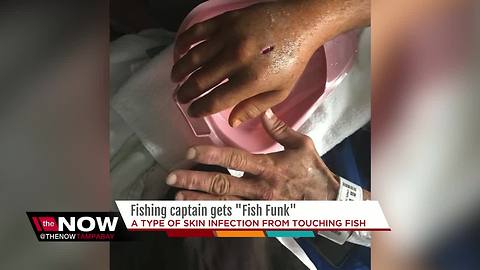 Florida fishing captain develops 'fish funk' after touching fish with open cut