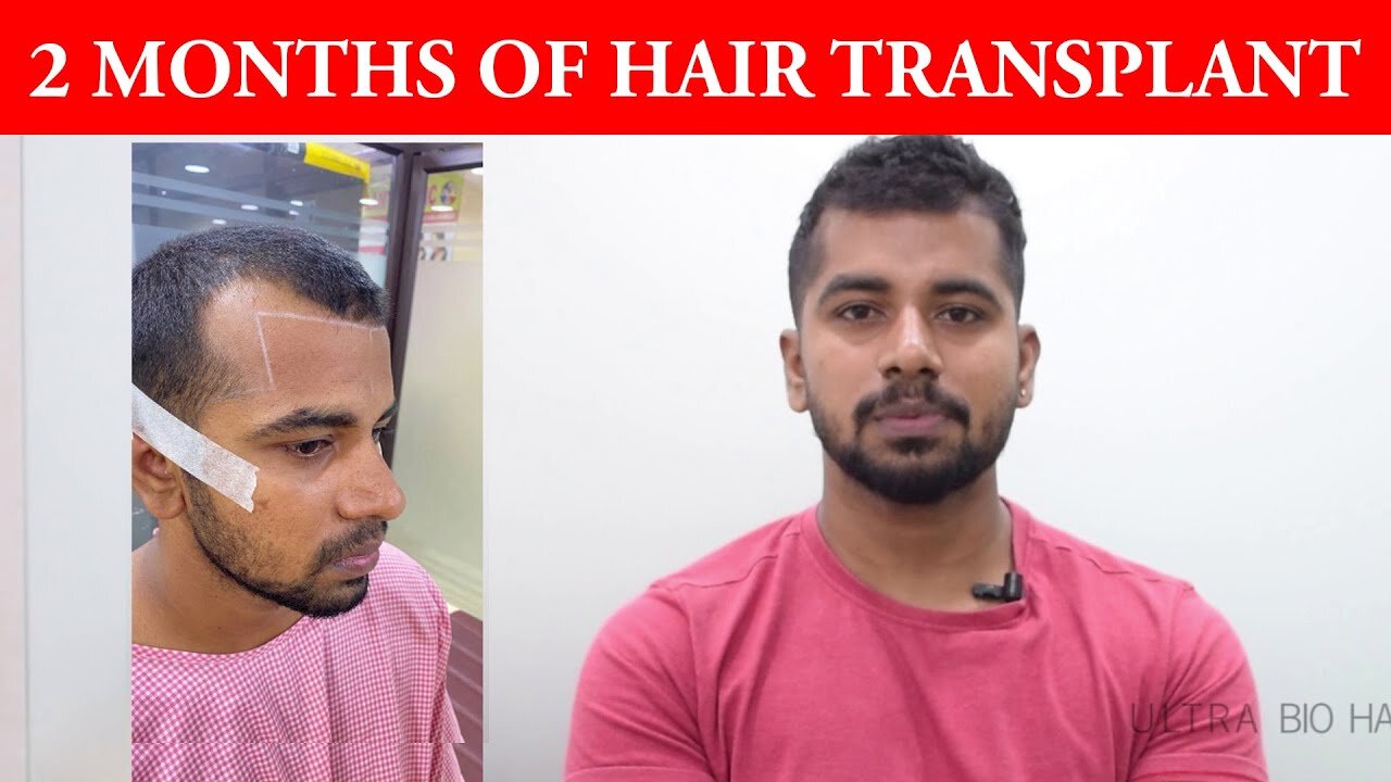 2 Months Hair Transplant Result