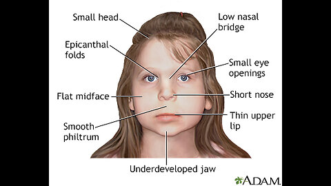 WHERE WHITE PPL CAME FROM: Fetal alcohol syndrome created people