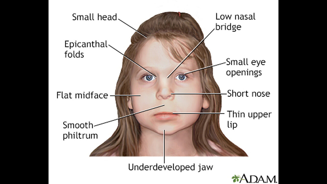 WHERE WHITE PPL CAME FROM: Fetal alcohol syndrome created people