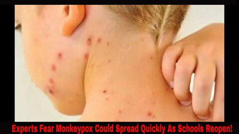 Experts Fear Monkeypox Could Spread Quickly As School Starts! Vaccines?