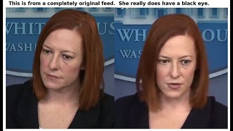 JEN PSAKI IS NOW PART OF THE "BLACK EYE" CLUB.