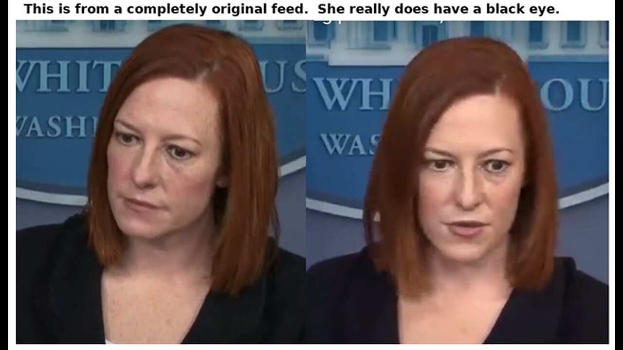JEN PSAKI IS NOW PART OF THE "BLACK EYE" CLUB.