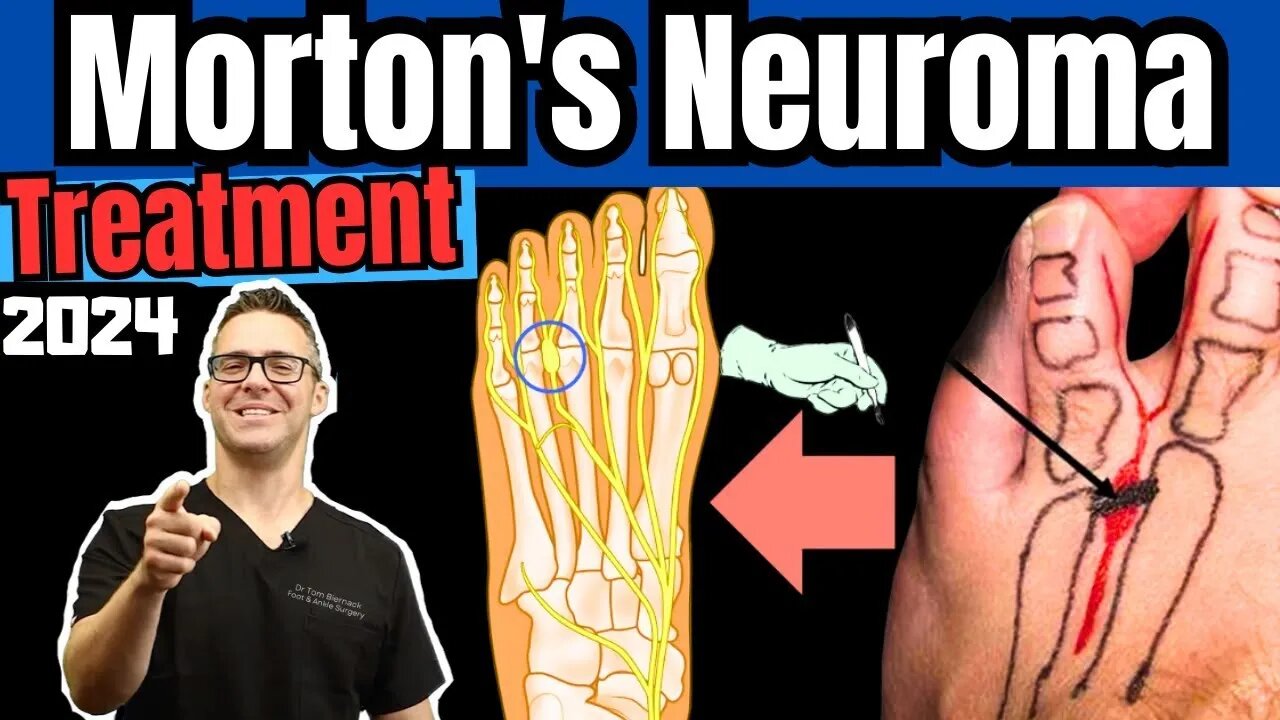 CURE Morton's Neuroma, Metatarsalgia & Ball of the Foot Pain FAST!