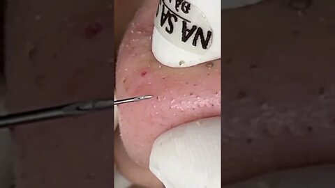 Satisfying & Relaxing Blackheads Nose Removal