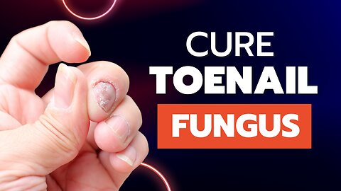 CURE Toenail Fungus (And keep it Gone FOREVER)