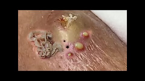 Satisfying blackhead Whiteheads removal relaxing PimplePopper Extraction