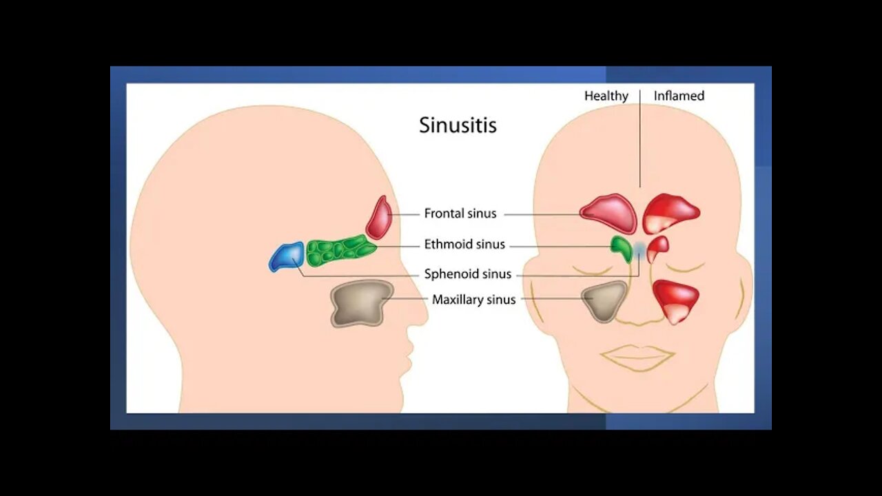 Sinusitis / Rhinosinusitis - Herbal remedies, nutritional supplements, ayurveda and TCM