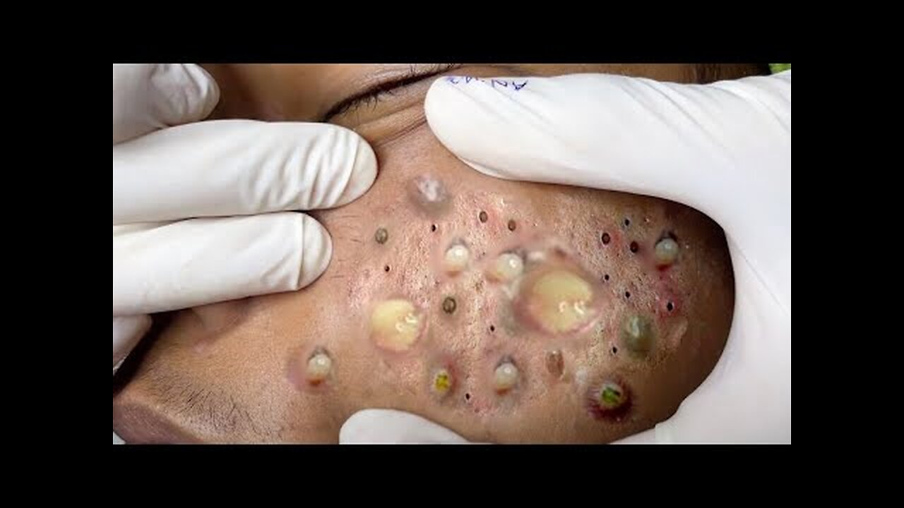 Satisfying blackhead removal, relaxing Pimple Popping 112