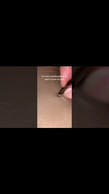 20 Year Old Blackhead Removal