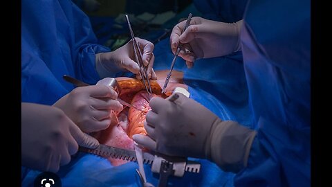 Heart transplant of A patient,