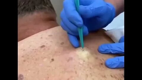 Remoção de Cravos e Espinhas - Remove Squeezing Blackheads and Pimples - Just Relax | Apenas Relaxe