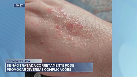 Doença Celíaca: Se não Tratada Corretamente pode Provocar Diversas Complicações.