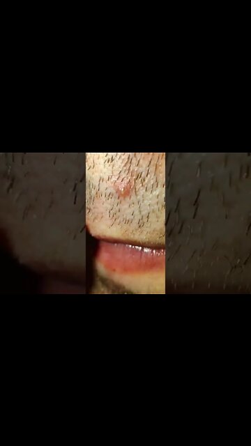 Enormous Ingrown Hair Removal