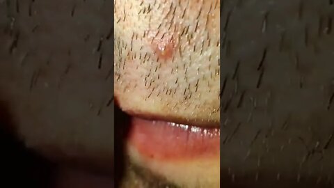 Enormous Ingrown Hair Removal