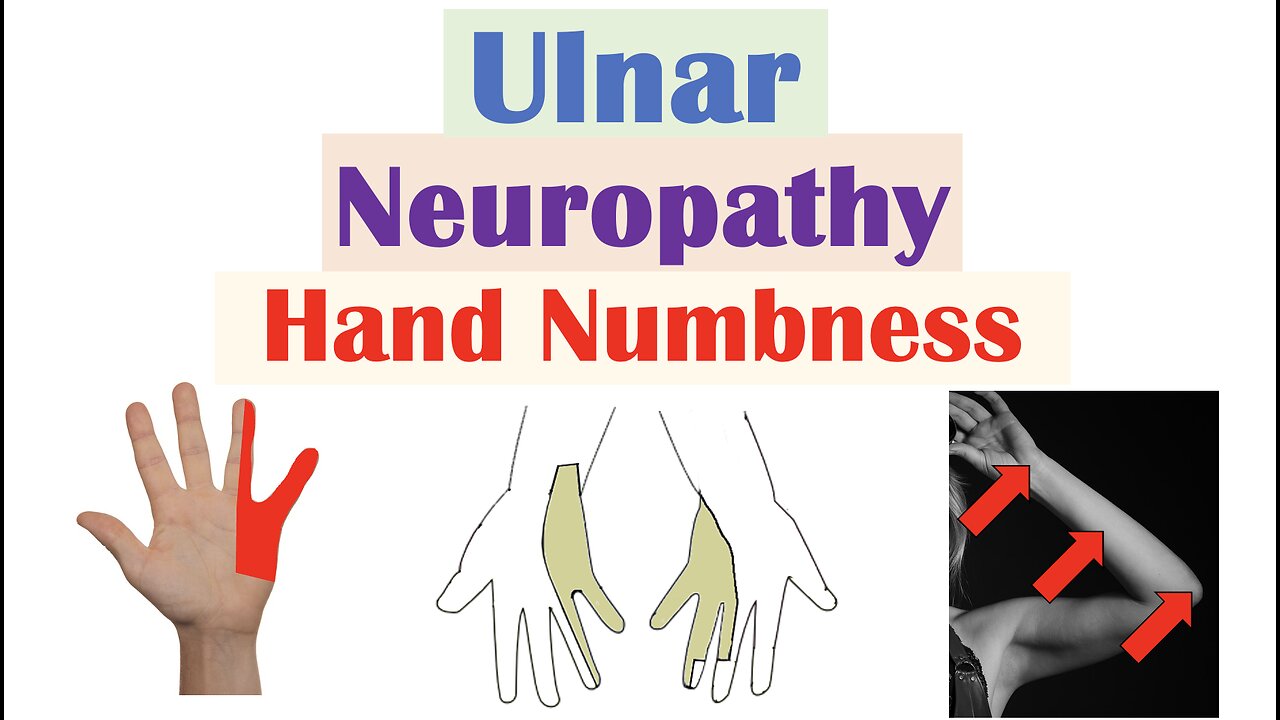 Ulnar Neuropathy (& Numbness in the Hand) | Causes, Signs & Symptoms, Diagnosis, Treatment