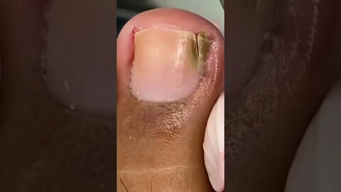 Infected Ingrown Toenail removal