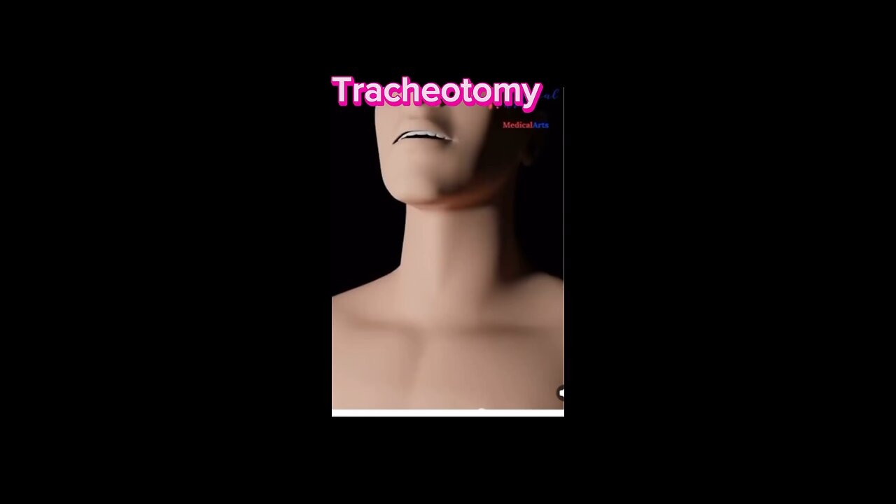 Tracheotomy