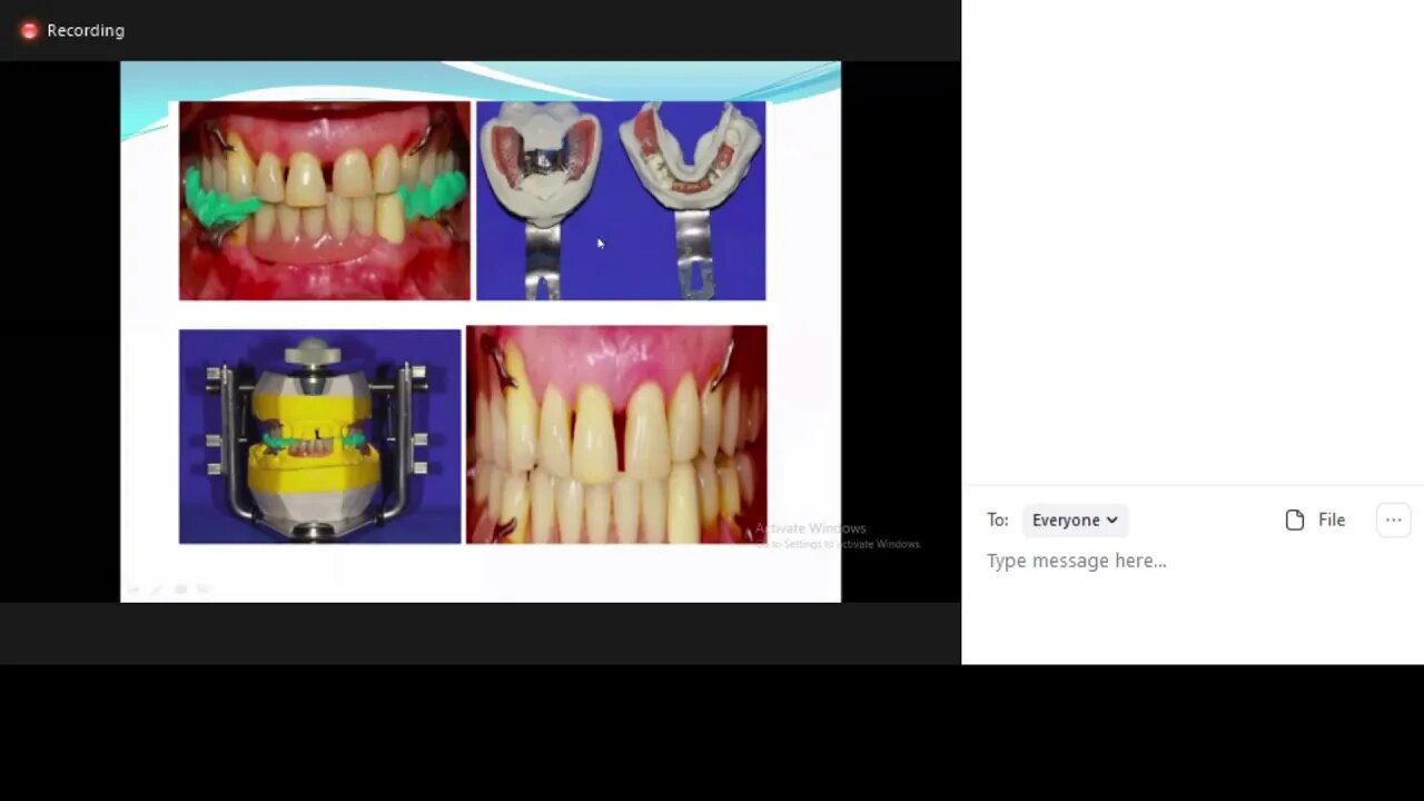 Prosthodontics L8 part2 (Correcting the occlusal contacts)