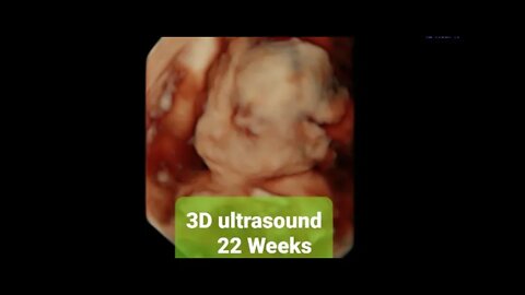 22 week 3D ultrasound