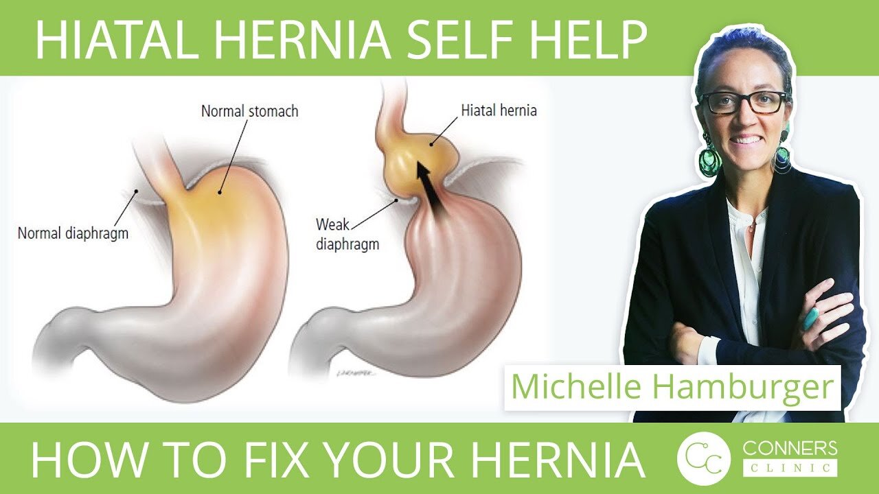 Hiatal Hernia Self Help