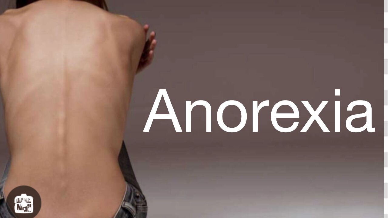 (05/13/2023) ANOREXIA: A LIFE KILLER