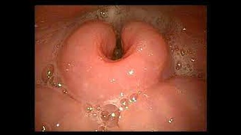 Pre bronchoscopy endoscopic exam in a patient after radiation therapy from AOD pt1425