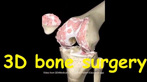 Bone surgery in 3D