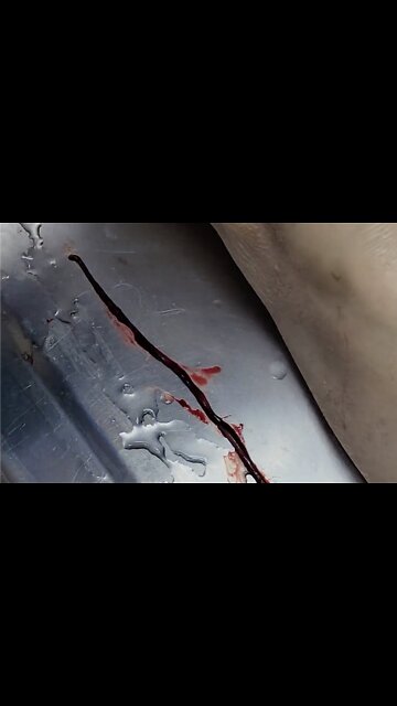 Unbelievable blood clots: video from embalmer Richard Hirschman