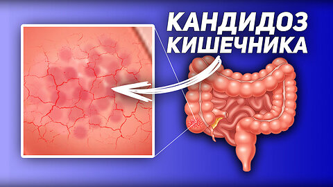 4 Препятствия на Пути Кандиды / Кандидоз Кишечника