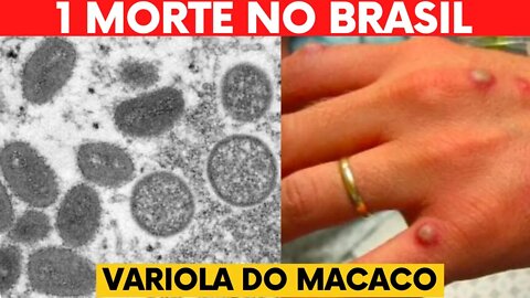 VARIOLA DO MACACO SINTOMAS