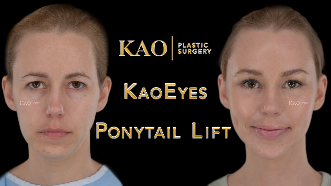 Picture Perfect Scarless Facelift | Plastic Surgery Before & After Video | Ponytail Lift | Dr Kao