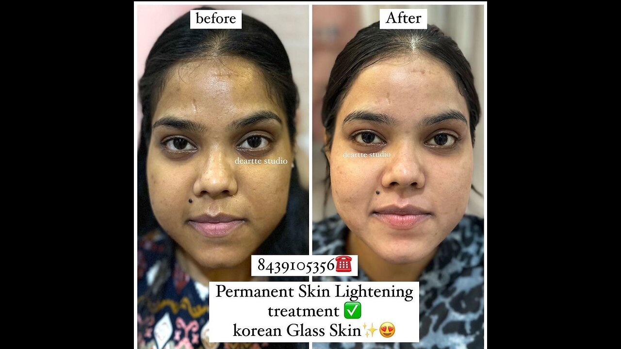 Skin lightening treatment for women