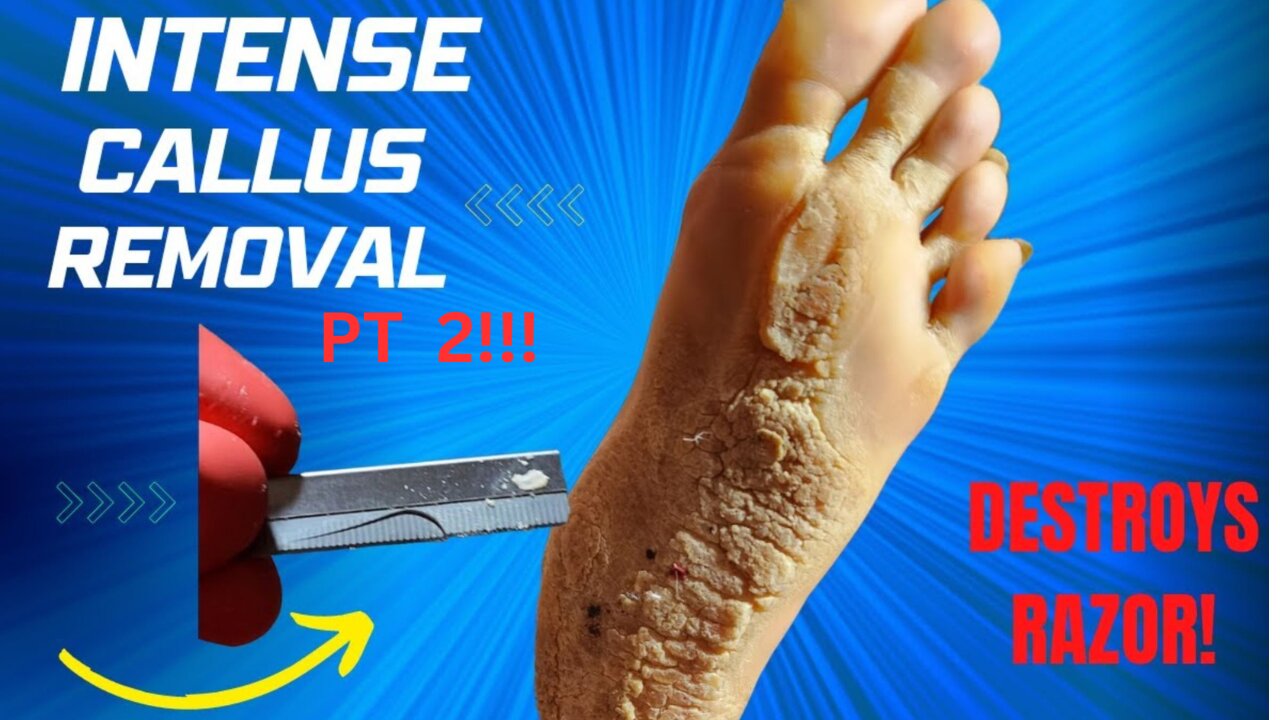 INTENSE CALLUS REMOVAL PT2